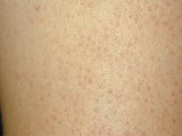 Keratosis Pilaris Pictures... Keratosis Pilaris on the arm