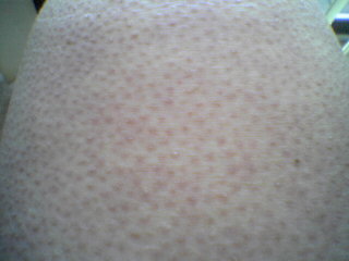 Keratosis pilaris on leg