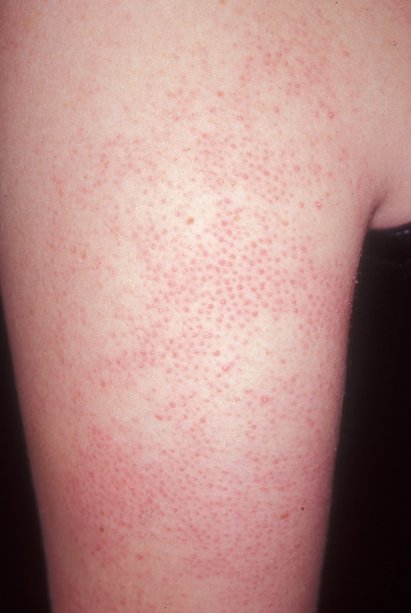 Keratosis pilaris on arm, up close