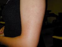 Keratosis pilaris on arm