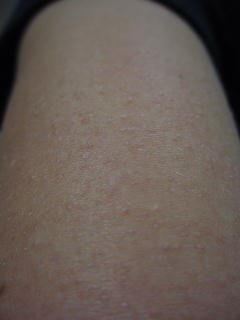 Keratosis pilaris on arm