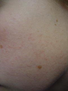 Keratosis pilaris on face